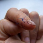 Stitches